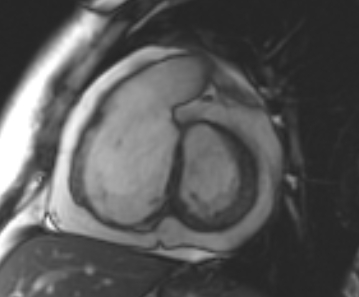Arrhythmogenic right ventricular cardiomyopathy (Radiopaedia 69431-79307 Short axis cine 175).jpg