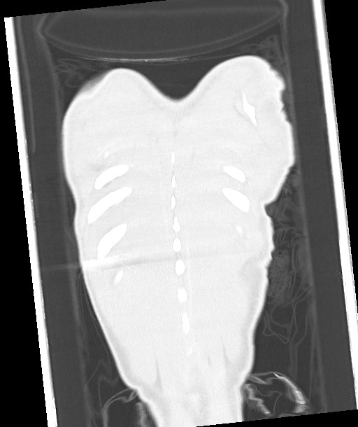 Arrow injury to the chest (Radiopaedia 85367-100975 Coronal lung window 120).jpg