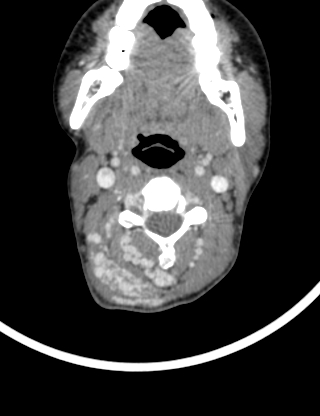 File:Arteriovenous malformation of the neck (Radiopaedia 53935-60062 B 18).jpg