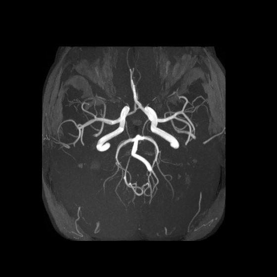 Artery of Percheron infarct (Radiopaedia 40966-43676 F 28).jpg