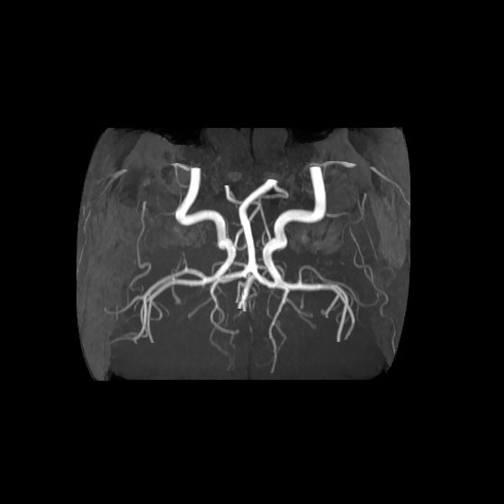 Artery of Percheron infarct (Radiopaedia 40966-43676 F 55).jpg