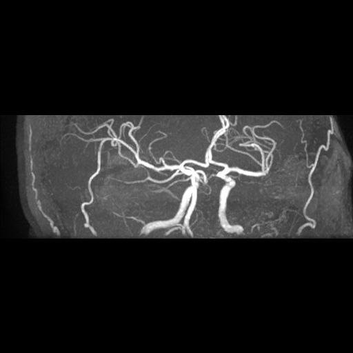 File:Artery of Percheron infarction (Radiopaedia 27975-28230 3D TOF 14).jpg