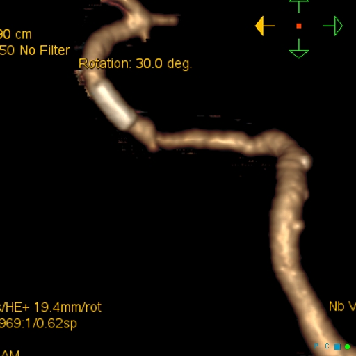 File:Artifactual basilar artery stenosis due to metallic stent (Radiopaedia 31206-31923 C 1).jpg
