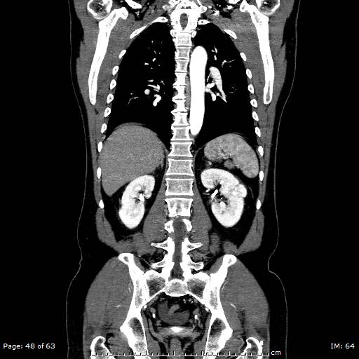 Ascending aortic aneurysm (Radiopaedia 50086-55404 B 48).jpg