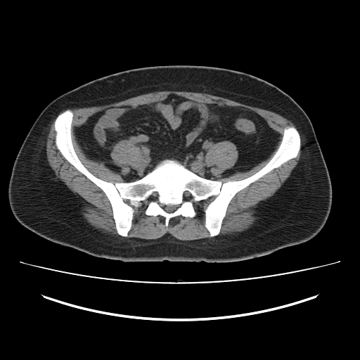 File:Ascending retrocecal appendicitis with liver abscesses (Radiopaedia 60066-67615 Axial non-contrast 63).jpg