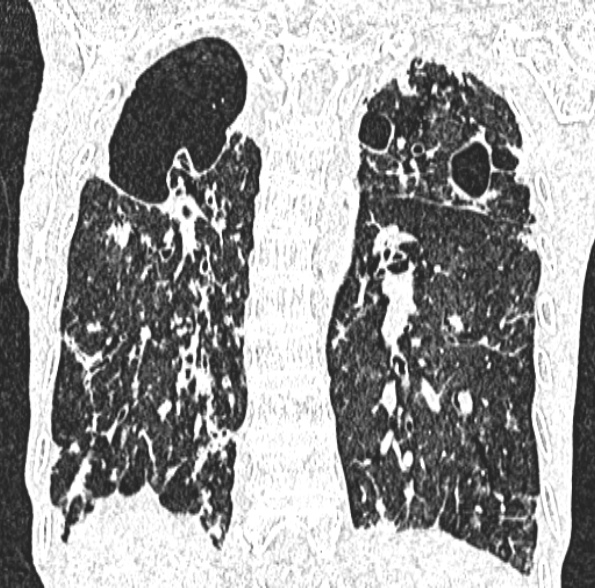 Aspergilloma- with Monod sign (Radiopaedia 44737-48532 Coronal lung window 326).jpg