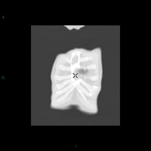 File:Aspergilloma (Radiopaedia 14842-14787 Coronal lung window 2).jpg