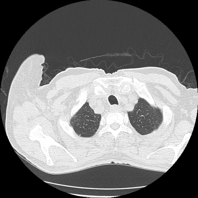 Aspergilloma (Radiopaedia 44592-48327 Axial lung window 3).jpg