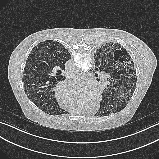 File:Aspergilloma on background pulmonary fibrosis (Radiopaedia 60942-68757 Axial lung window 11).jpg