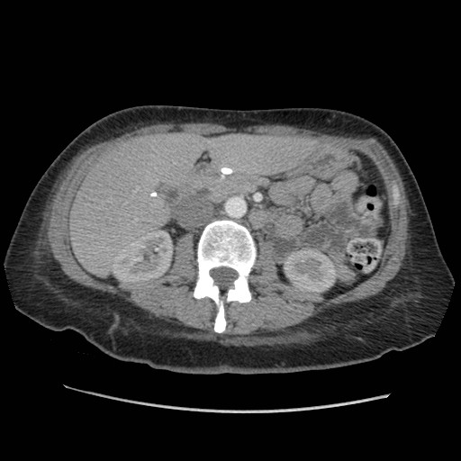 Aspiration pneumonia secondary to laparoscopic banding (Radiopaedia 18345-18183 A 65).jpg