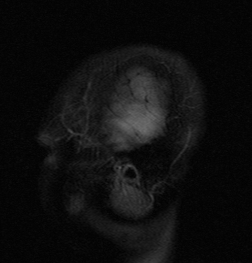 File:Astrocytoma - WHO grade II (Radiopaedia 16279-15959 Sagittal FLAIR 2).jpg