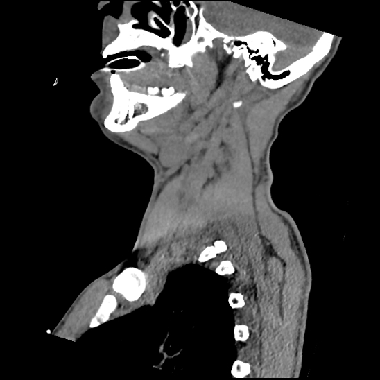 Atlanto-occipital dissociation (Traynelis type 1), C2 teardrop fracture, C6-7 facet joint dislocation (Radiopaedia 87655-104061 D 26).jpg