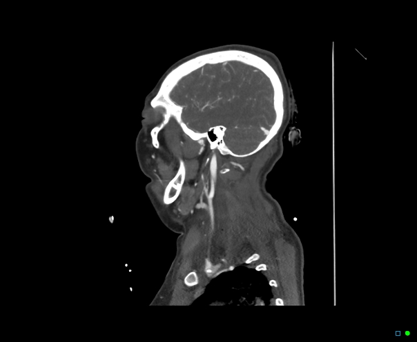 Atlanto-occipital dissociation - Traynelis type 1 (Radiopaedia 87570-103949 C 44).jpg