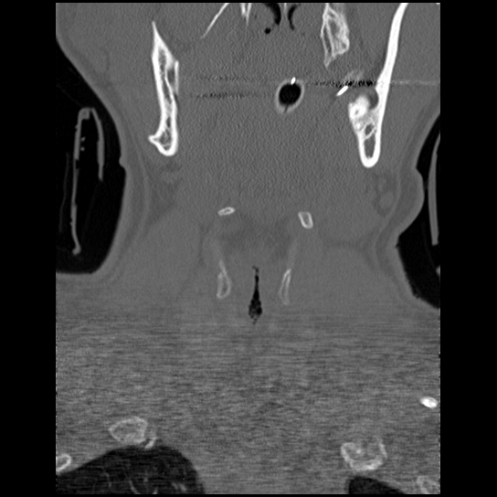 Atlanto-occipital dissociation injury (Radiopaedia 29274-29698 Coronal bone window 48).png