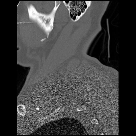 Atlanto-occipital dissociation injury (Radiopaedia 29274-29698 Sagittal bone window 1).png
