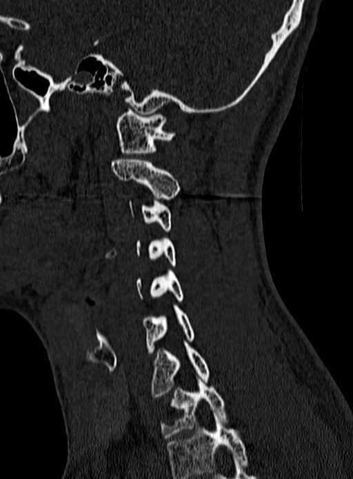 Atlantoaxial subluxation (Radiopaedia 44681-48450 Sagittal bone window 123).jpg