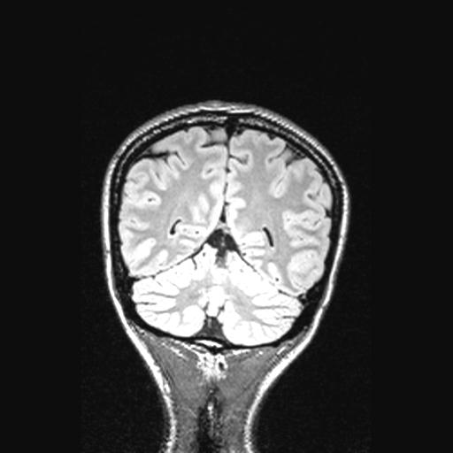 Atretic encephalocoele with inferior vermis hypoplasia (Radiopaedia 30443-31108 Coronal FLAIR 51).jpg