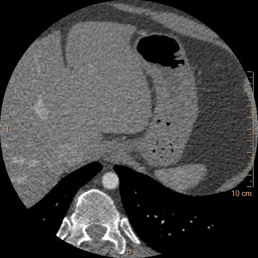 Atrial septal defect (upper sinus venosus type) with partial anomalous pulmonary venous return into superior vena cava (Radiopaedia 73228-83961 A 287).jpg