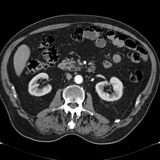 File:Atypical hepatocellular carcinoma (Radiopaedia 41744-44698 A 49).jpg