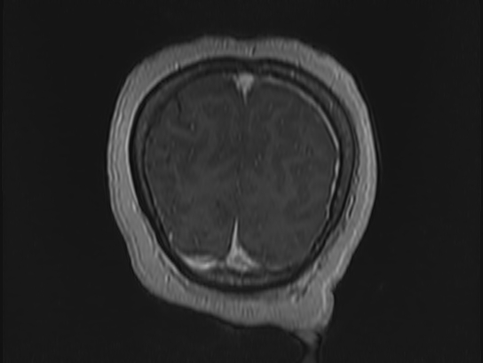 File:Atypical meningioma (Radiopaedia 62985-71406 Coronal T1 C+ 117).jpg