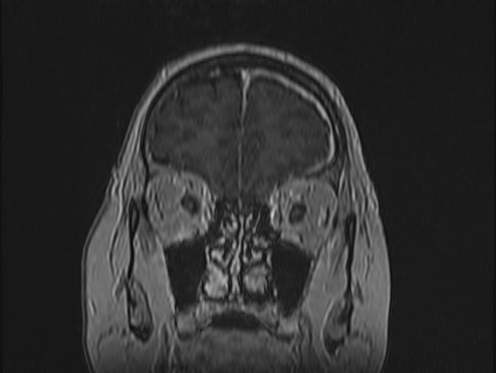 Atypical meningioma (Radiopaedia 62985-71406 Coronal T1 C+ 17).jpg
