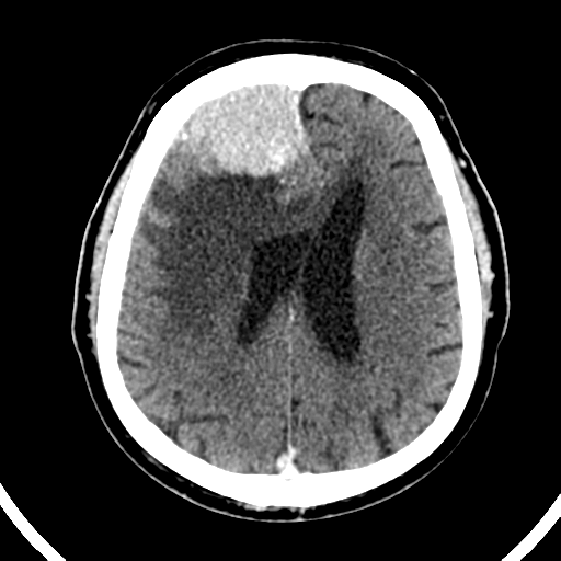 Atypical meningioma (WHO grade II) with brain invasion (Radiopaedia 57767-64728 Axial C+ 21).png