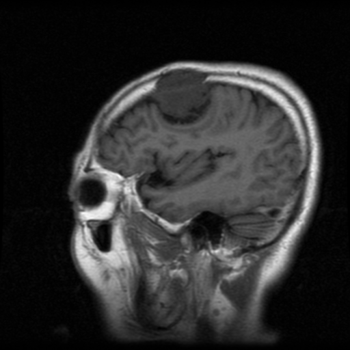 File:Atypical meningioma with skull invasion (Radiopaedia 34357-35648 Sagittal T1 18).png