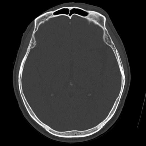 Atypical meningioma with skull invasion (Radiopaedia 34357-35649 Axial bone window 40).png