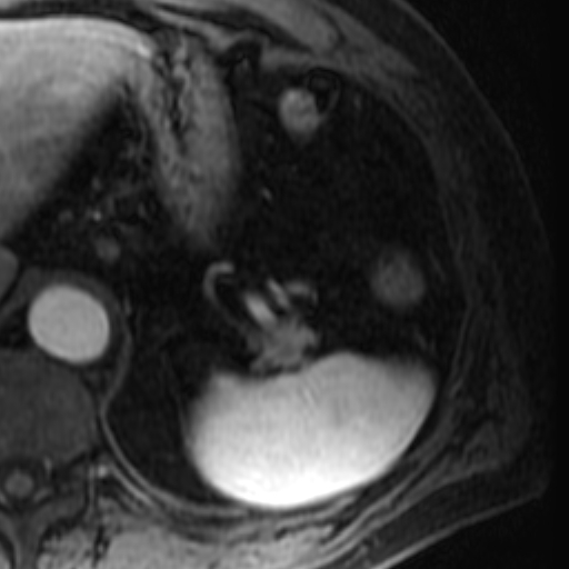 File:Atypical renal cyst on MRI (Radiopaedia 17349-17046 C 1).jpg