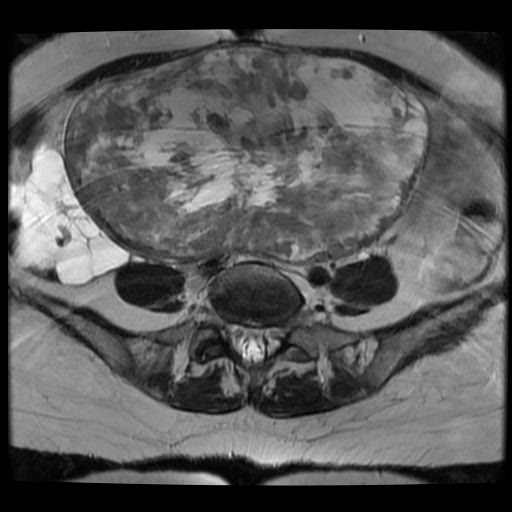 File:Atypical retroperitoneal lymphocoeles with large leiomyoma of uterus (Radiopaedia 32084-33027 Axial T2 10).jpg
