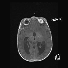 File:Atypical teratoid rhabdoid tumor (prenatal US and neonatal MRI) (Radiopaedia 59091-66388 Axial T1 28).jpg
