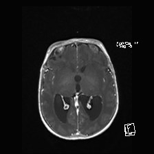 File:Atypical teratoid rhabdoid tumor (prenatal US and neonatal MRI) (Radiopaedia 59091-66388 Axial T1 C+ 31).jpg
