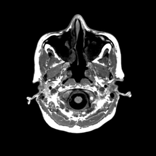Autoimmune limbic encephalitis (Radiopaedia 30363-31005 T1 Axial 1mm 18).jpg