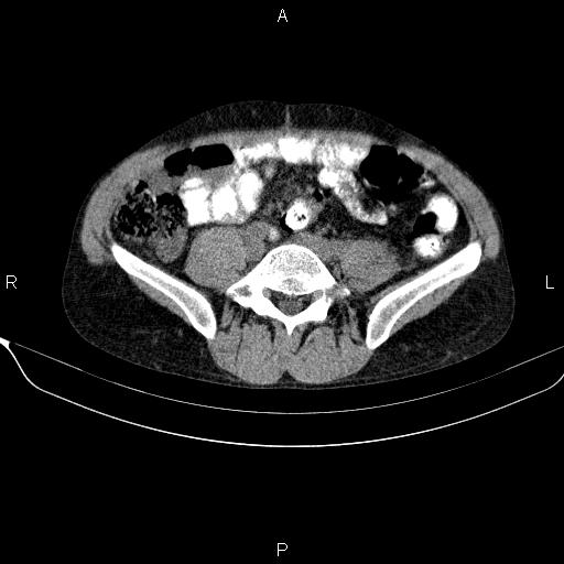 Autoimmune pancreatitis (Radiopaedia 84925-100431 Axial non-contrast 37).jpg