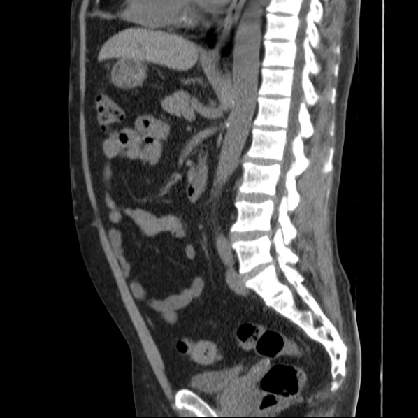 File:Autosomal dominant polycystic kidney disease (Radiopaedia 36539-38101 D 46).jpg