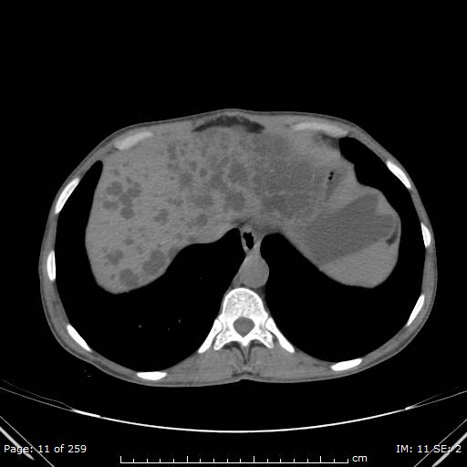 Autosomal dominant polycystic kidney disease (Radiopaedia 44122-47684 Axial non-contrast 4).jpg