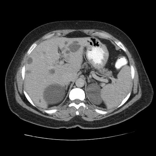 Autosomal dominant polycystic kidney disease with hepatic involvement (Radiopaedia 32693-33662 C 16).jpg