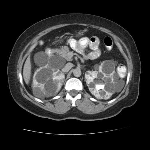 File:Autosomal dominant polycystic kidney disease with hepatic involvement (Radiopaedia 32693-33662 C 28).jpg