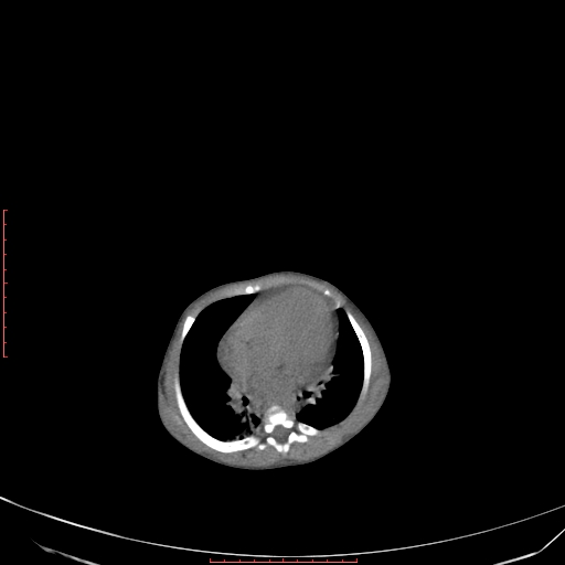 Autosomal recessive polycystic kidney disease associated with Caroli disease (Radiopaedia 61932-69984 B 64).jpg