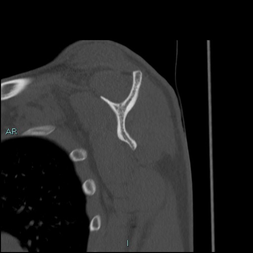 Avascular necrosis after fracture dislocations of the proximal humerus (Radiopaedia 88078-104653 Sagittal bone window 47).jpg