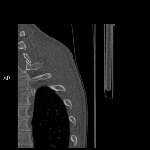 Avascular necrosis after fracture dislocations of the proximal humerus (Radiopaedia 88078-104655 Sagittal bone window 99).jpg