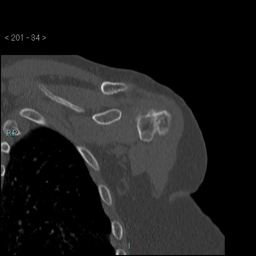 Avascular necrosis of the shoulder - Cruess stage I (Radiopaedia 77674-89887 Coronal bone window 33).jpg