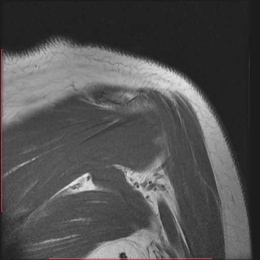 File:Avulsion fracture - greater tuberosity of humerus (Radiopaedia 25457-25703 Coronal T1 12).jpg