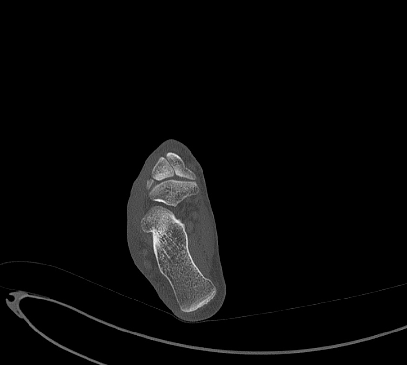 Avulsion fractures of talus and calcaneus (Radiopaedia 48277-53155 Axial bone window 70).jpg
