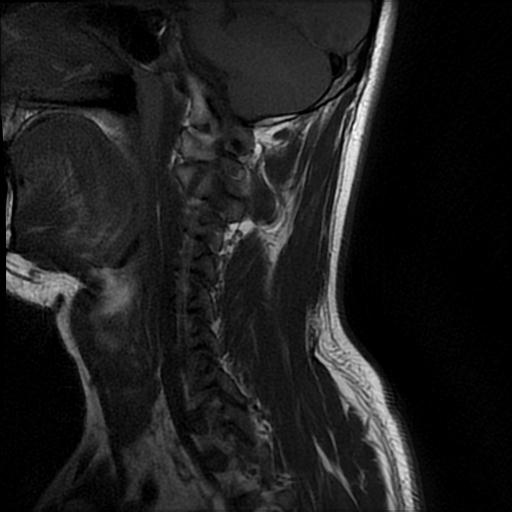 File:Axis fracture - MRI (Radiopaedia 71925-82375 Sagittal T1 8).jpg