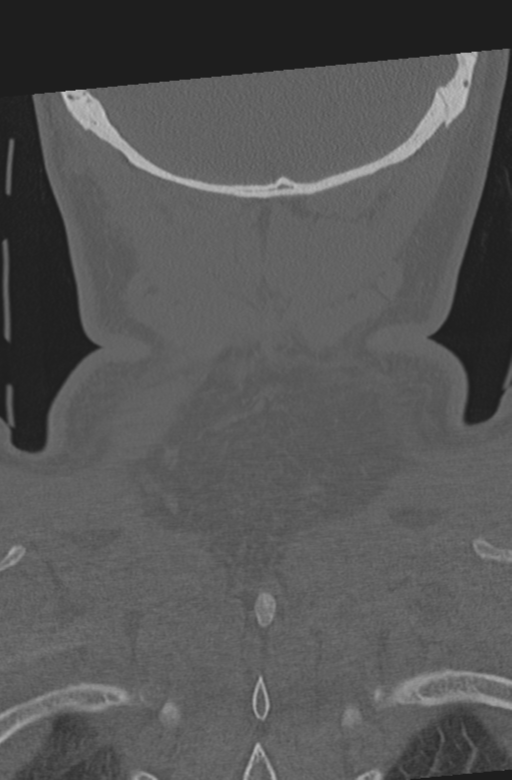 Axis peg fracture (type 3) and atlas lateral mass (type 4) fracture (Radiopaedia 37474-39324 Coronal bone window 61).png