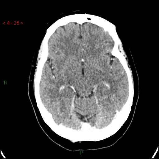 Azygos anterior cerebral artery (Radiopaedia 51987-57833 A 26).jpg