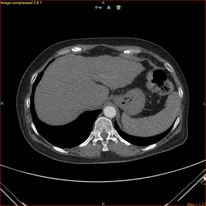 Azygos vein aneurysm (Radiopaedia 77824-90130 B 47).jpg
