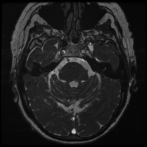 File:Balo concentric sclerosis (Radiopaedia 53875-59982 Axial T2 FIESTA 52).jpg