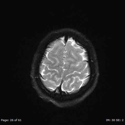 Balo concentric sclerosis (Radiopaedia 61637-69636 I 185).jpg